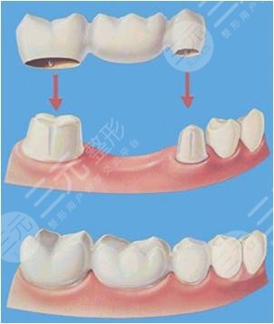 烤瓷牙的優(yōu)點