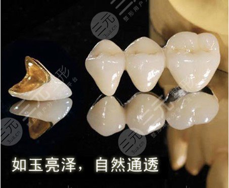 烤瓷牙的優(yōu)點