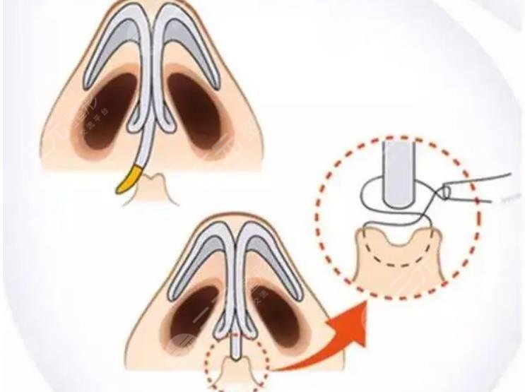 鼻翼縮小手術有風險嗎?