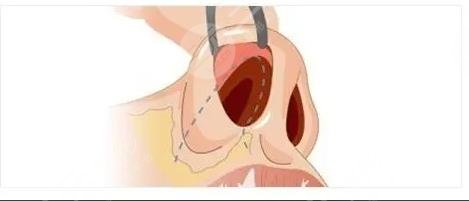 鼻翼縮小手術有風險嗎?