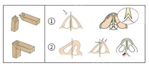 膨體隆鼻后遺?癥有哪些?