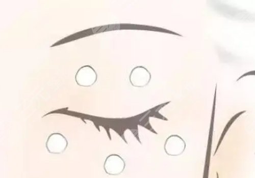 眼周圍有脂肪粒怎么引起的？