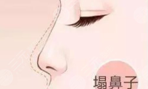 奧美定隆鼻有什么副作用？