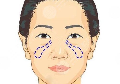 蘋果肌斷層是什么原因？