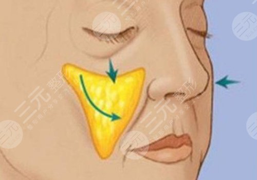蘋果肌斷層是什么原因？