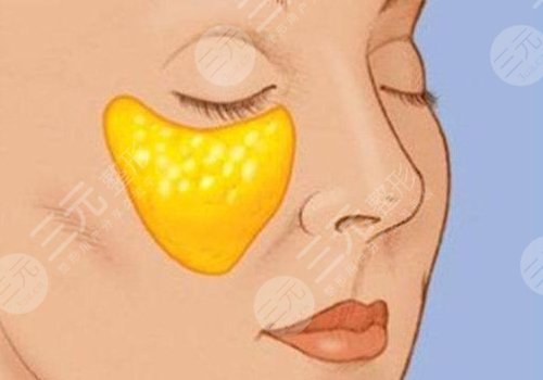 蘋果肌斷層是什么原因？