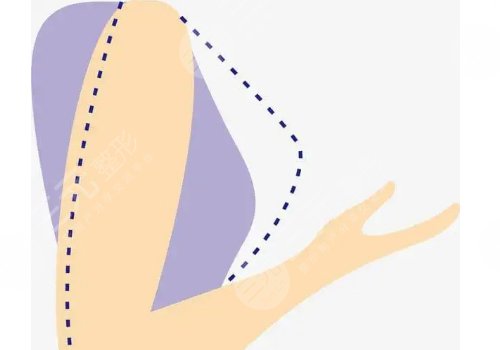 奧美定取出手術(shù)后要注意些什么？