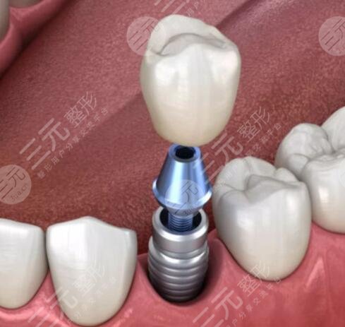 種植牙的利與弊都有哪些？做種植牙的優(yōu)勢(shì)與劣勢(shì)深入分析，使用壽命幾年？