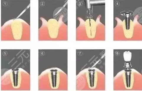 種植牙的使用壽命有多長(zhǎng)？