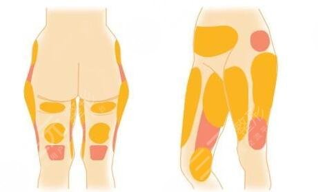 腿部吸脂減肥價(jià)格貴嗎2023