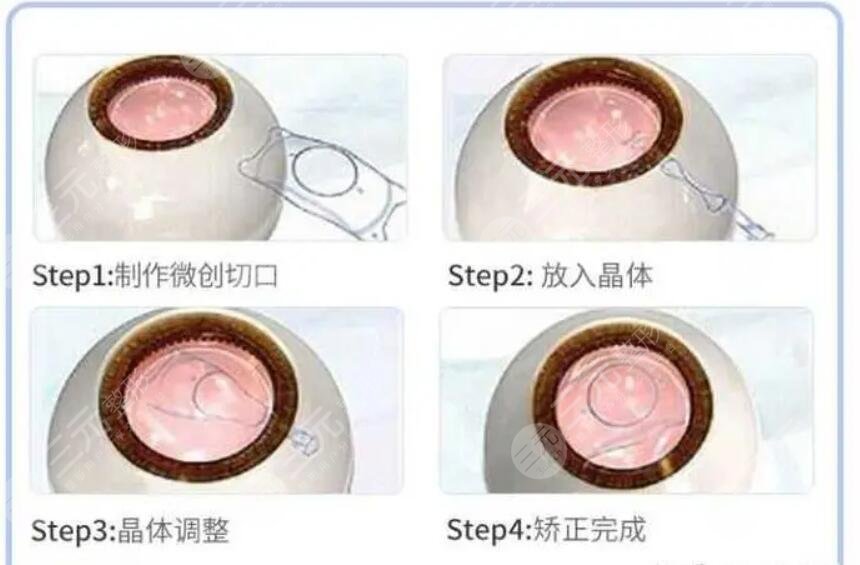 激光手術(shù)治近視眼會反彈嗎?