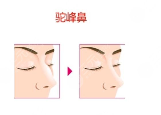 駝峰鼻手術(shù)一般多少錢?