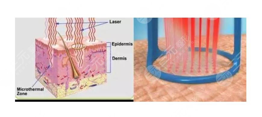 眼周圍有脂肪粒怎么引起的？
