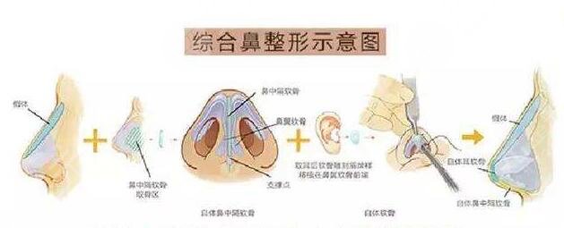 假體隆鼻效果如何?
