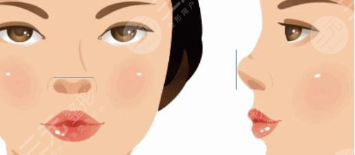 假體隆鼻手術(shù)術(shù)后如何去護(hù)理?