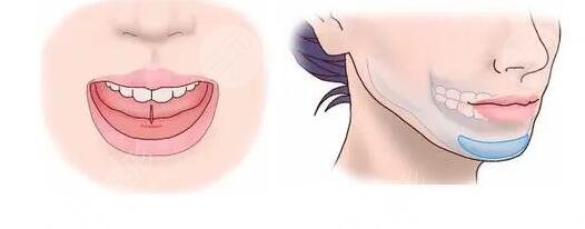 墊下巴多長(zhǎng)時(shí)間恢復(fù)正常?