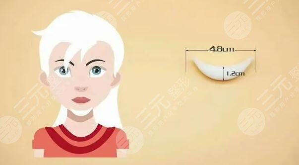 墊下巴多長(zhǎng)時(shí)間恢復(fù)正常?