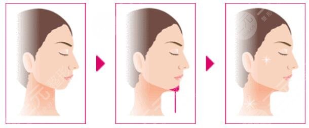 墊下巴手術(shù)的注意事項(xiàng)