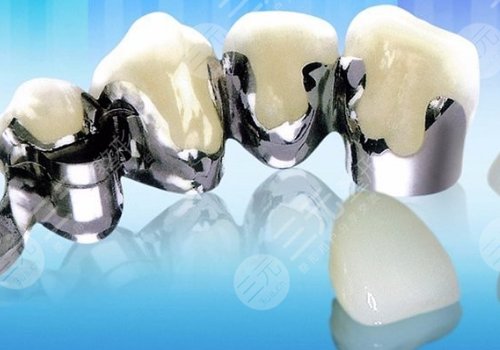 鈷鉻烤瓷牙和全瓷牙哪個(gè)好？