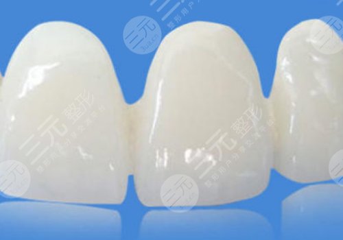 鈷鉻烤瓷牙和全瓷牙哪個(gè)好？