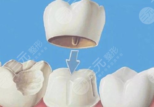 鈷鉻烤瓷牙和全瓷牙哪個(gè)好？