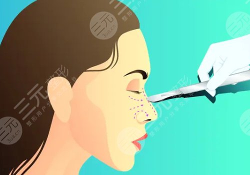 隆鼻有什么危害和后遺癥嗎？