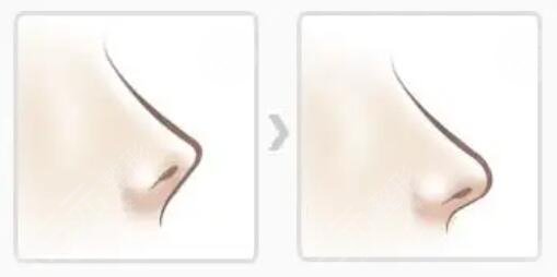 高順福和羅勇誰的技術(shù)好？2位名醫(yī)從技術(shù)、手術(shù)細(xì)節(jié)、審美傾向多方比拼~