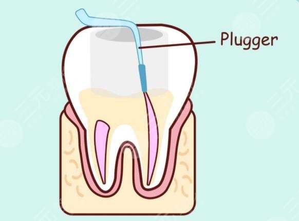 哪些情況下就要做根管緩解呢?