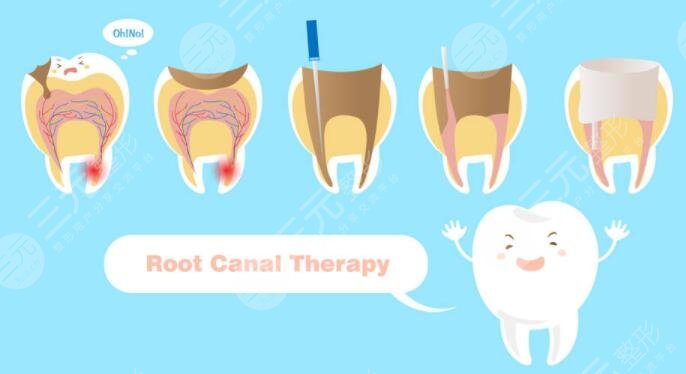 根管緩解的過(guò)程當(dāng)中需要?dú)⑸窠?jīng)嗎?
