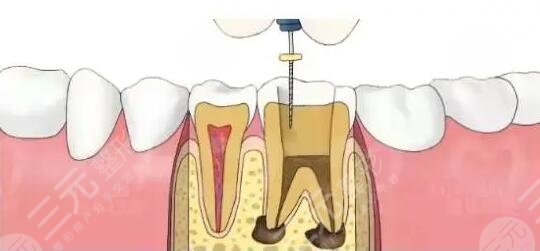 根管緩解手術(shù)安全嗎?