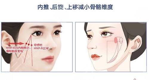 北京協(xié)和醫(yī)院磨骨案例