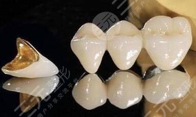 鈦合金烤瓷牙套的注意事項(xiàng)
