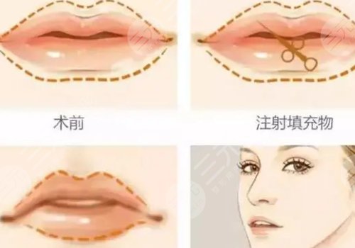 瑞蘭2號(hào)玻尿酸適合打哪里？