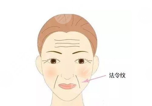 瑞蘭2號(hào)玻尿酸適合打哪里？