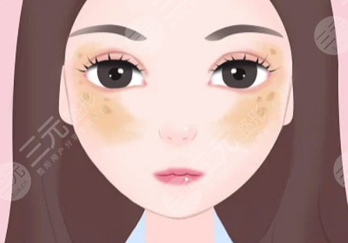 去除黃褐斑價格是多少？