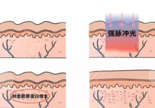 激光去疤痕需要幾次才能徹底消除？