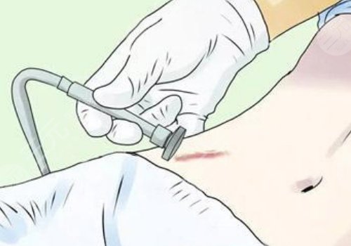 激光去疤痕需要幾次才能徹底消除？