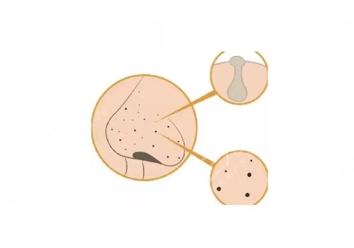 去黑頭收縮毛孔好的方法有哪些？