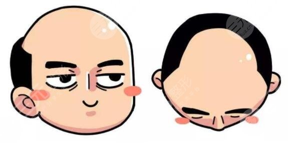 上海緩解脫發(fā)多少錢2023？藥物、手術(shù)、日常護理多方位入手，解救禿頭星人！