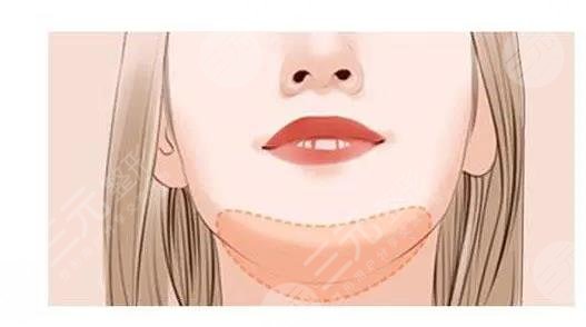 瑞蘭2號(hào)玻尿酸適合打哪里？