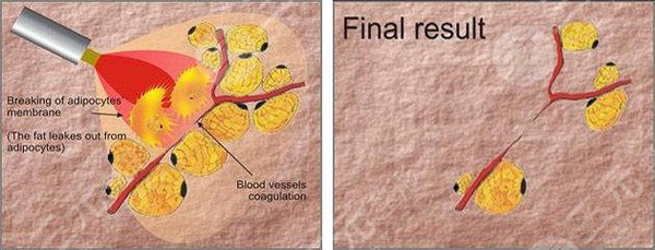 鐳射溶脂有效果嗎？