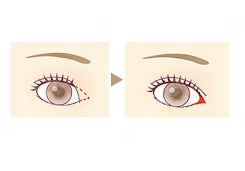 開內(nèi)眼角一般多少錢？