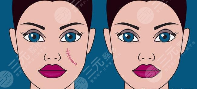 像素激光去疤效果怎么樣？要做多少次才行？技術(shù)優(yōu)點(diǎn)及是否安全？