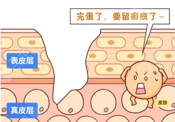 像素激光祛疤手術(shù)安全嗎?