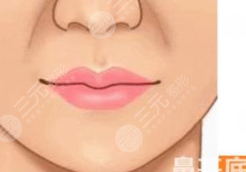 鼻基底注射玻尿酸會移位嗎？