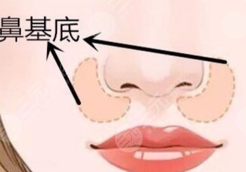 鼻基底注射玻尿酸會移位嗎？