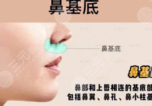 鼻基底注射玻尿酸會移位嗎？