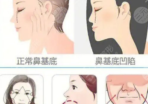 鼻基底注射玻尿酸會移位嗎？