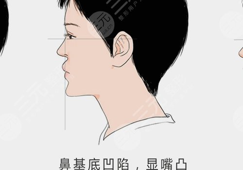 鼻基底注射玻尿酸會移位嗎？