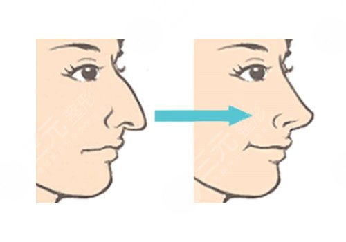 駝峰鼻矯正手術(shù)多少錢？